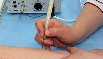 Como desfacerse dos papilomas no corpo