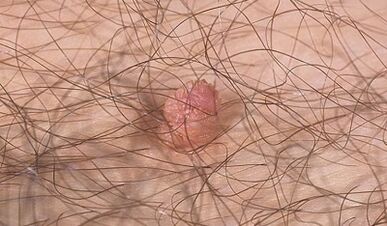 Formas de transferir o virus do papiloma humano