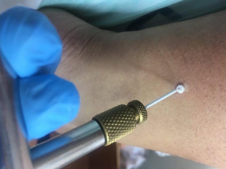 formas de eliminar as verrugas