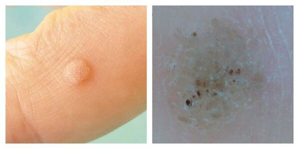Verruga ordinaria durante o exame e a dermatoscopia